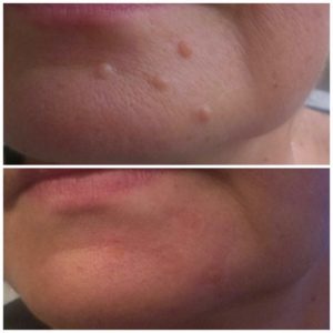 Accor Nf+ Plasma Pen/Beauty Corrector
