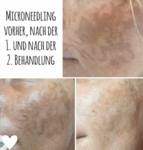 Vorher Nacher Microneedling Hautklar