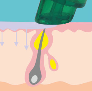 Schritt2-aqua-facial
