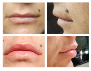 lippenvolumenaufbau