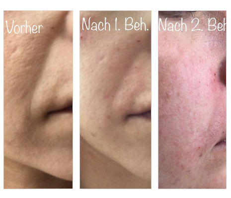 lippenvolumenaufbau2