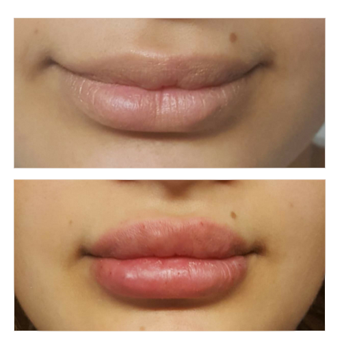 lippenvolumenaufbau4